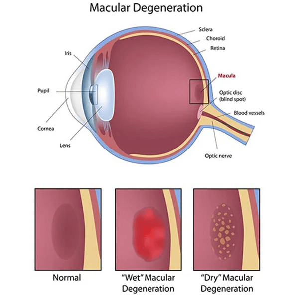 Refractive Errors