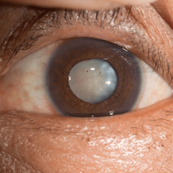 Refractive Errors