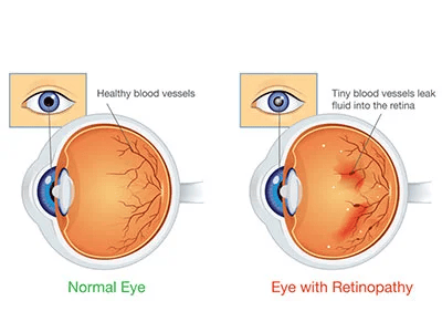 Refractive Errors