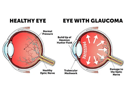 Refractive Errors