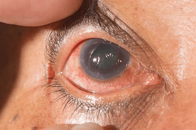 Cataract