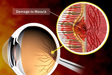 Glaucoma