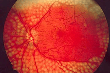 Vitreoretinal